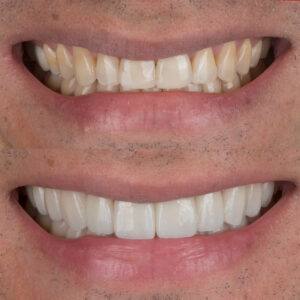 Carillas Geovany sonrisa