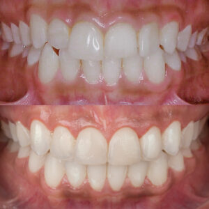 Laura Negrete Antes y Dsps