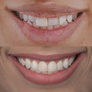 Laura Negrete Antes y Dsps Sonrisa 2
